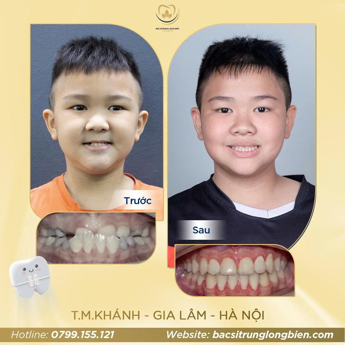 Ca niềng răng cắn ngược trước và sau tại Nha khoa Bác sĩ Trung Long Biên