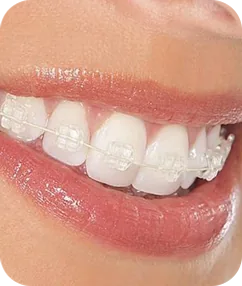Niềng răng để có nụ cười đẹp – Niềng răng ở đâu là tốt nhất? - Nha khoa Bác sĩ Trung Long Biên