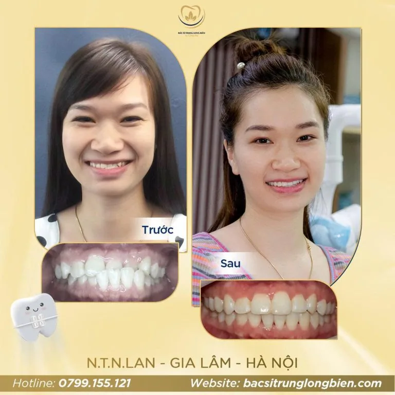Răng chen chúc ‑ ảnh trước và sau điều trị tại Nha khoa Bác sĩ Trung Long Biên