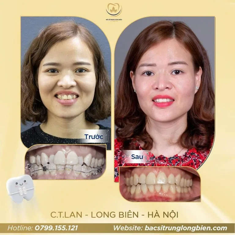 Chen chúc răng 2 hàm ‑ ảnh trước và sau điều trị tại Nha khoa Bác sĩ Trung Long Biên