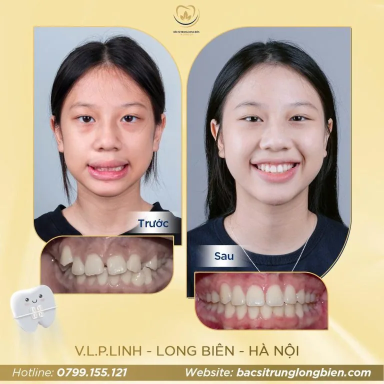 Hô, thưa răng hàm trên ‑ ảnh trước và sau điều trị tại Nha khoa Bác sĩ Trung Long Biên