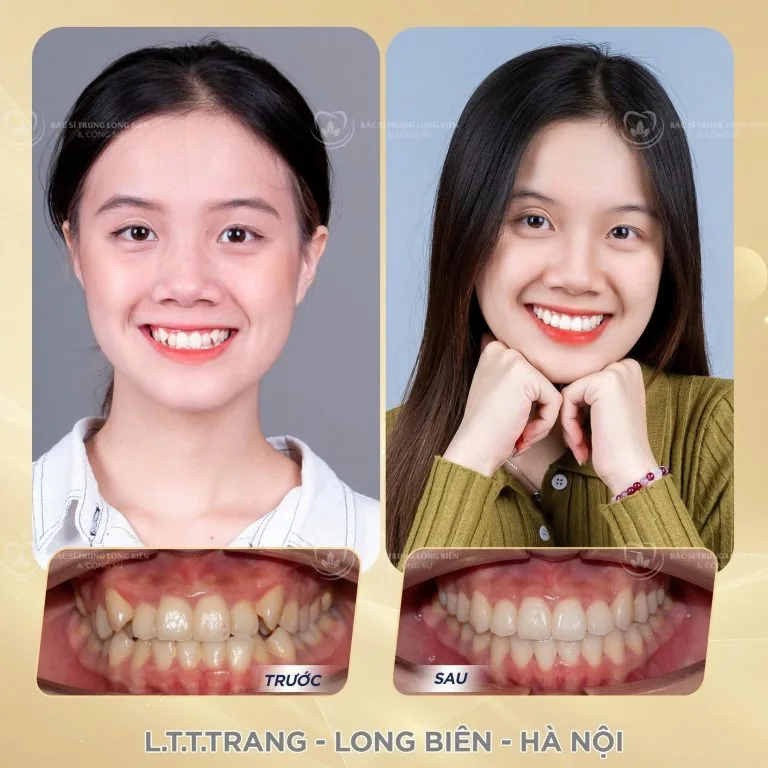Hẹp hàm 2 bên, chen chúc răng cửa ‑ ảnh trước và sau điều trị tại Nha khoa Bác sĩ Trung Long Biên