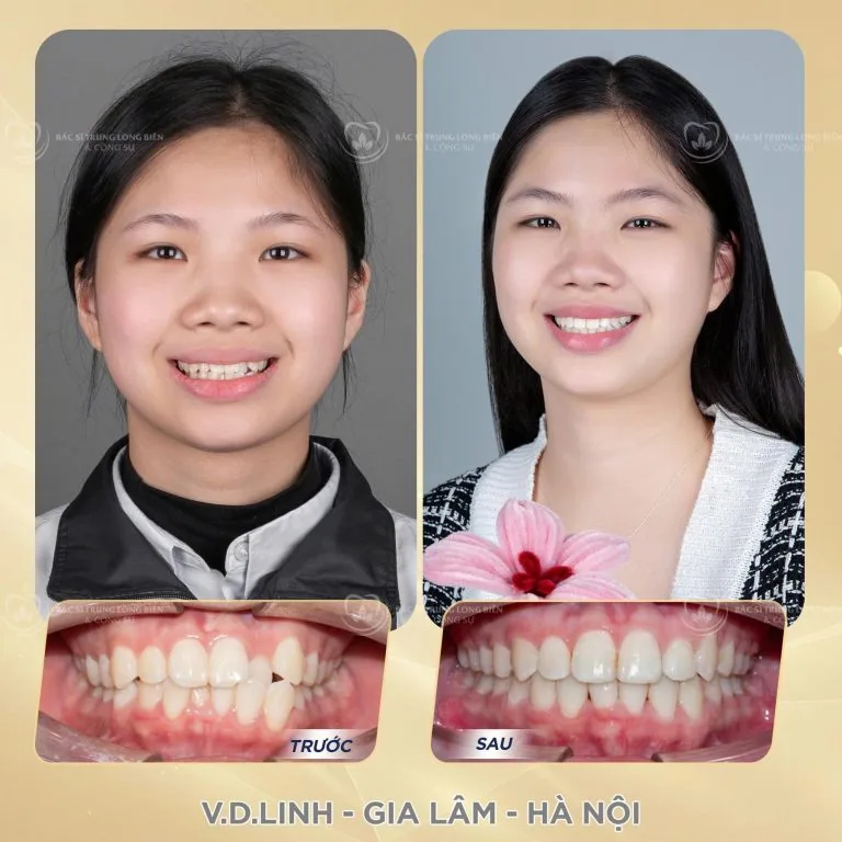 Chen chúc hàm dưới, cắn chéo R22 ‑ ảnh trước và sau điều trị tại Nha khoa Bác sĩ Trung Long Biên