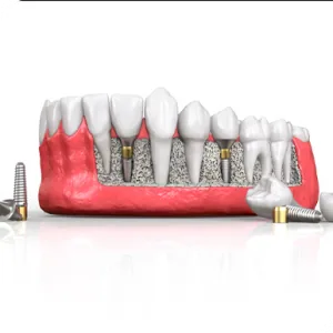 Implant