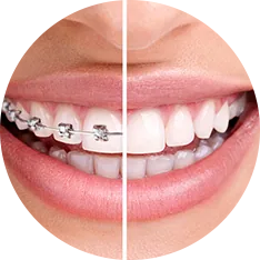 Kết thúc niềng răng - Nha khoa Bác sĩ Trung Long Biên