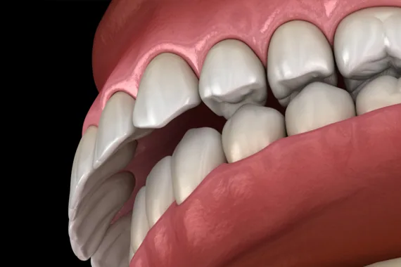 Các loại sai khớp cắn - Tình trạng sai khớp cắn nào thường gặp nhất