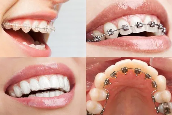Lựa chọn niềng răng - Bí kíp lựa chọn loại niềng răng mắc cài phù hợp