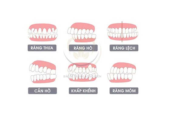 Niềng răng ở trẻ - Các tiêu chí quyết định chi phí niềng răng là gì?
