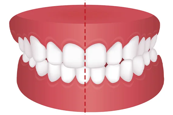 Khớp cắn chéo là gì? Nguyên nhân &amp; Phương pháp điều trị tình trạng!