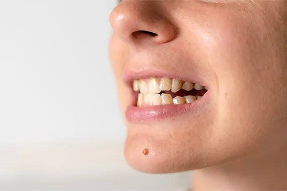 Khớp cắn đối đầu là gì? Nguyên nhân và phương pháp điều trị!