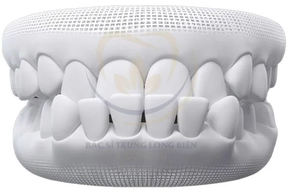 Khớp cắn ngược - Chỉnh nha sẽ giúp cải thiện như thế nào?