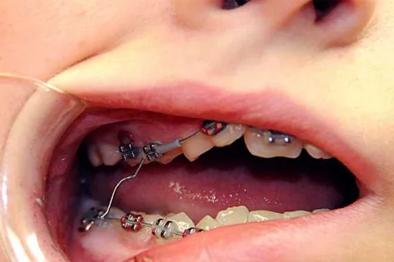 Dây cung chọc má - Niềng răng mắc cài và những vấn đề bất cập!