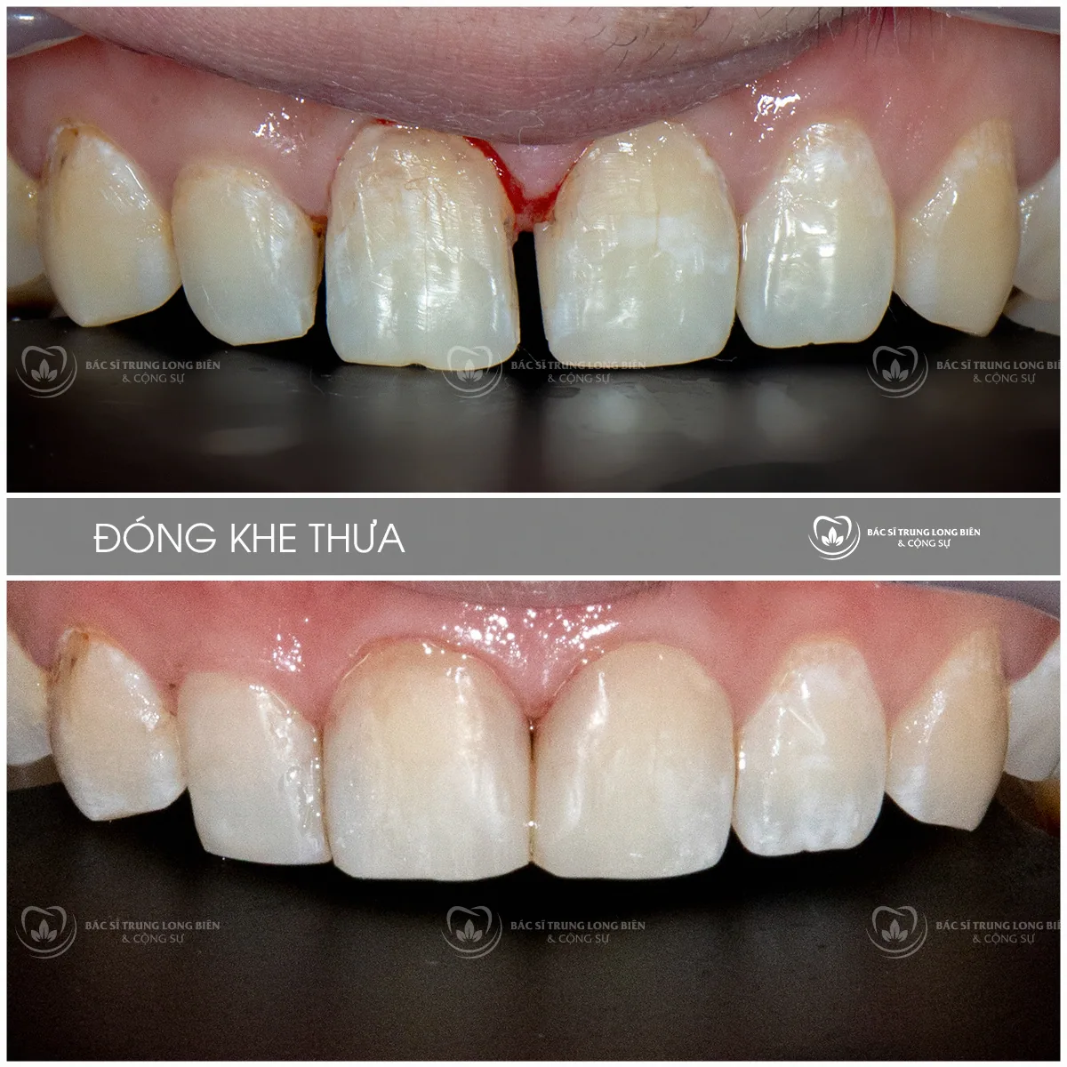 Ca đóng khe thưa bằng Bioclear trước và sau tại Nha khoa Bác sĩ Trung Long Biên