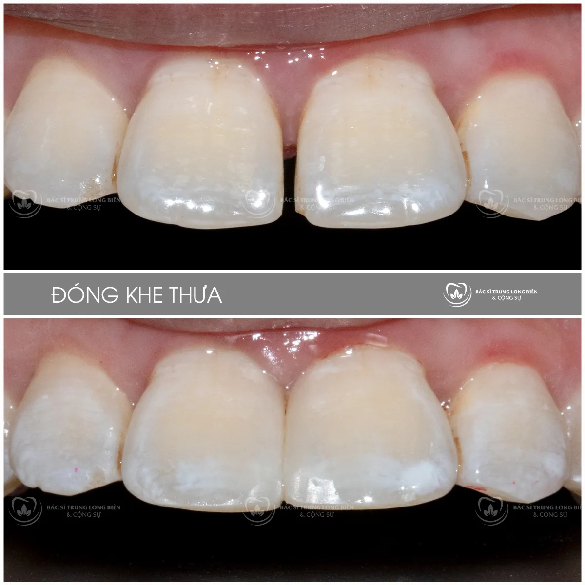 Ca đóng khe thưa răng cửa trước và sau tại Nha khoa Bác sĩ Trung Long Biên