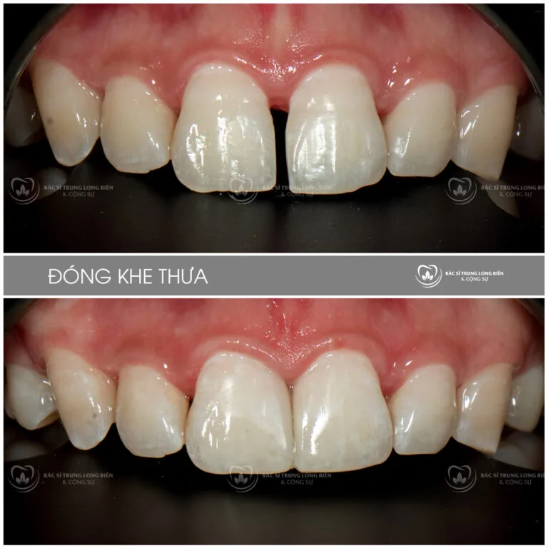 Đóng khe thưa răng cửa giữa ‑ ảnh trước và sau điều trị tại Nha khoa Bác sĩ Trung Long Biên
