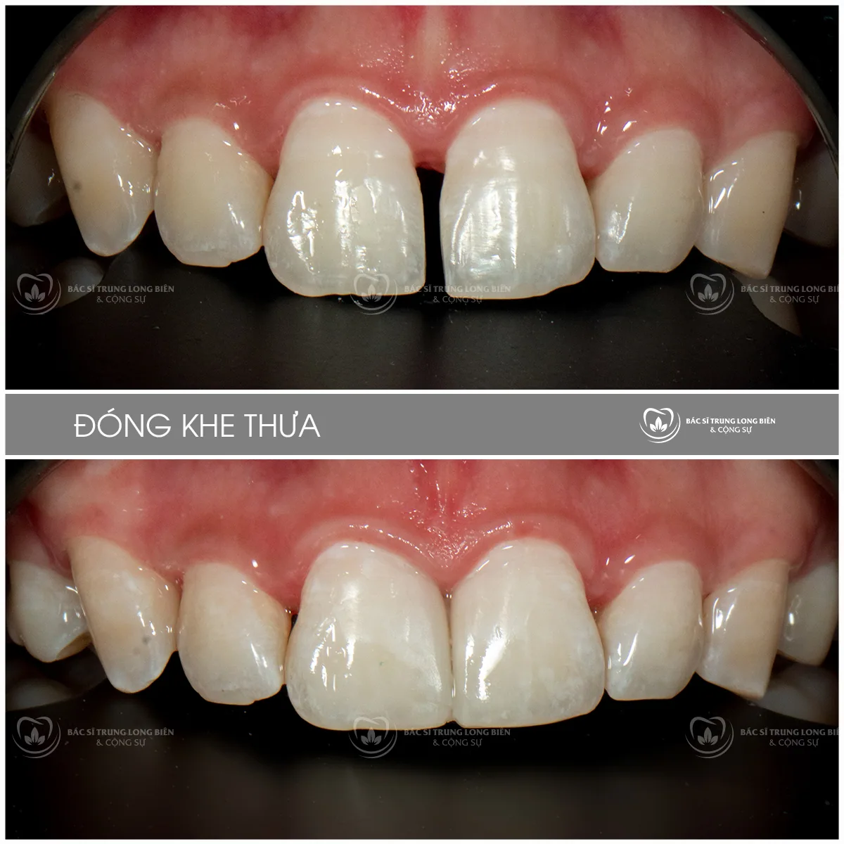 Ca đóng tam giác đen do khe thưa chân răng trước và sau tại Nha khoa Bác sĩ Trung Long Biên