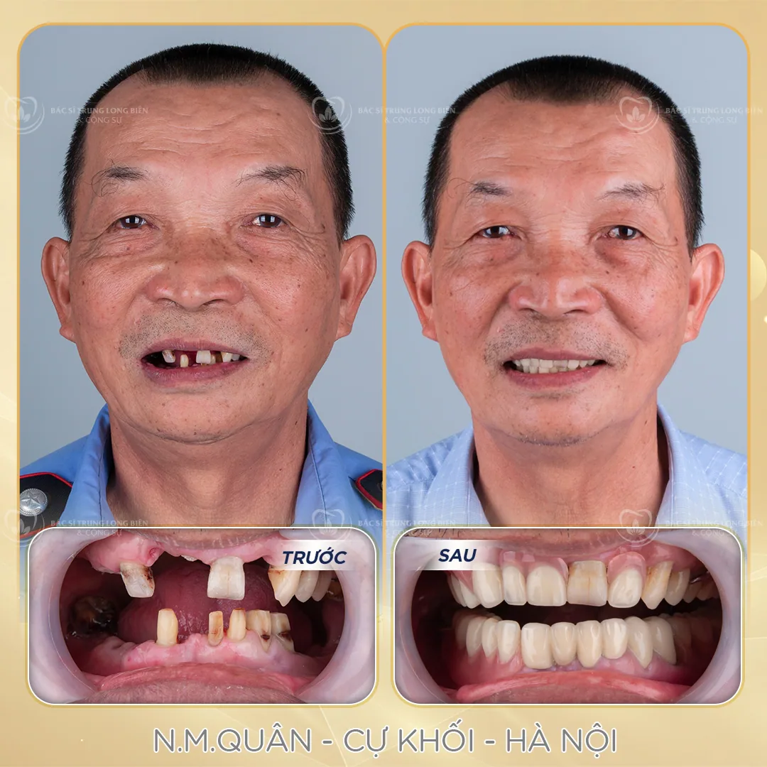 Ca hàm tháo lắp bán phần trước và sau tại Nha khoa Bác sĩ Trung Long Biên