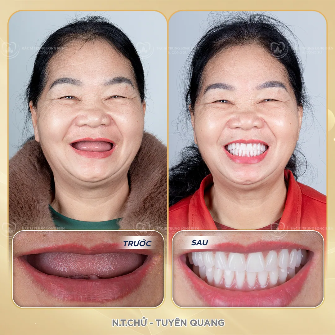 Ca hàm tháo lắp toàn hàm trước và sau tại Nha khoa Bác sĩ Trung Long Biên