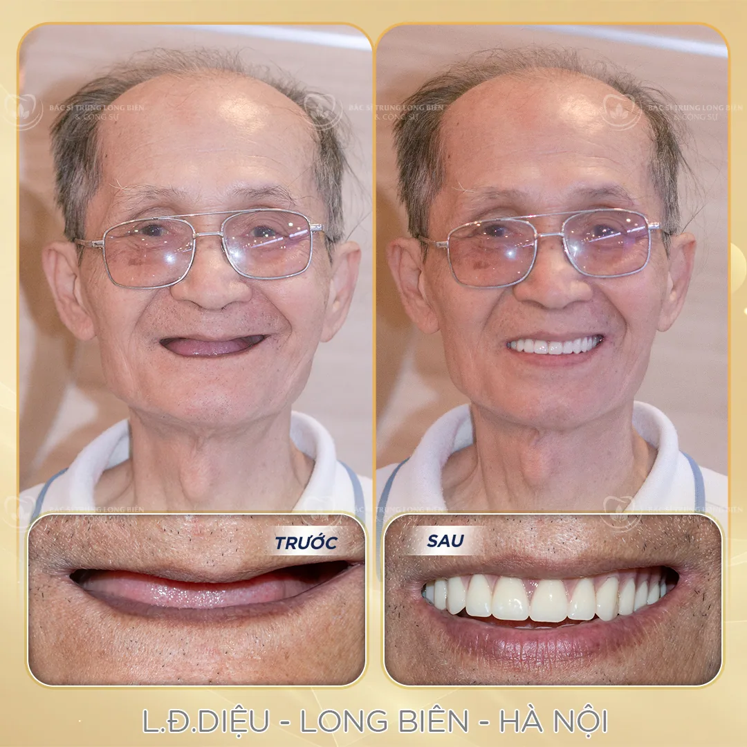 Hàm tháo lắp toàn hàm phục hình mất răng tại Nha khoa Bác sĩ Trung Long Biên