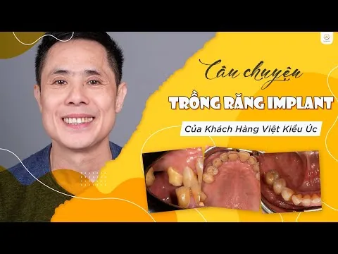 Câu Chuyện Trải Nghiệm Trồng Răng Implant Của Khách Hàng Việt Kiều Úc ‑ Nha khoa Bác sĩ Trung Long Biên