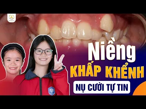 Từ Răng Khấp Khểnh Đến Nụ Cười Tự Tin: Hành Trình 2 Năm Nhìn Lại ‑ Nha khoa Bác sĩ Trung Long Biên
