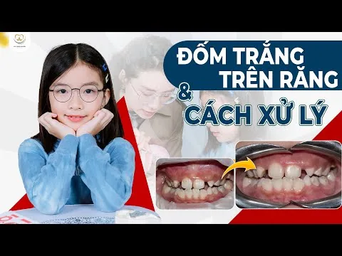 Đốm Trắng Trên Răng Và Cảm Nhận Của Chị Ngọc Sau Khi Bé Điều Trị ‑ Nha khoa Bác sĩ Trung Long Biên
