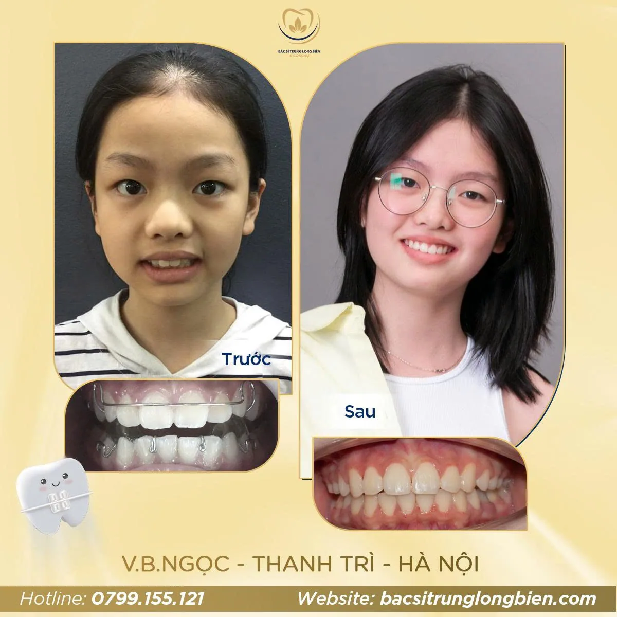 Ca niềng răng hô, chen chúc — hình ảnh trước và sau điều trị tại Nha khoa Bác sĩ Trung Long Biên