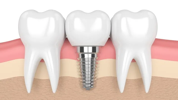 Trồng răng Implant - Nha khoa Bác sĩ Trung Long Biên