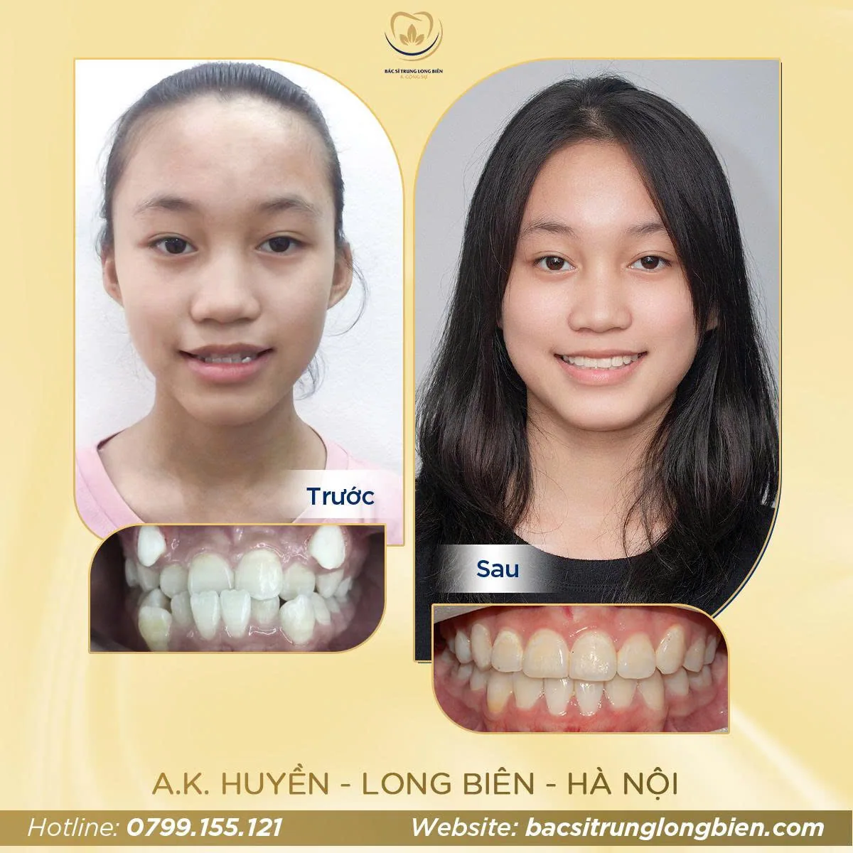 Ca niềng răng cắn chéo — hình ảnh trước và sau điều trị tại Nha khoa Bác sĩ Trung Long Biên