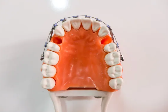 Nhổ răng số 8 khi niềng răng: khi nào cần và vì sao
