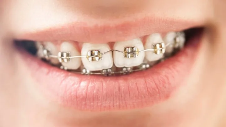 Niềng răng chỉnh nha - Nha khoa Bác sĩ Trung Long Biên