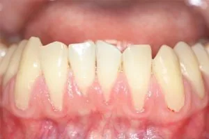 Cách điều trị tụt lợi: khi nào cần can thiệp | BS Trung