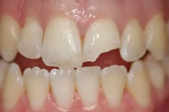 Răng bị gãy phải làm sao? - Bác sĩ Trung Long Biên