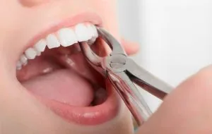 Chăm sóc sau nhổ răng - Nha khoa bác sĩ Trung Long Biên