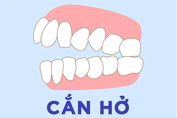 Khớp cắn hở – Biểu hiện, nguyên - Bác sĩ Trung Long Biên