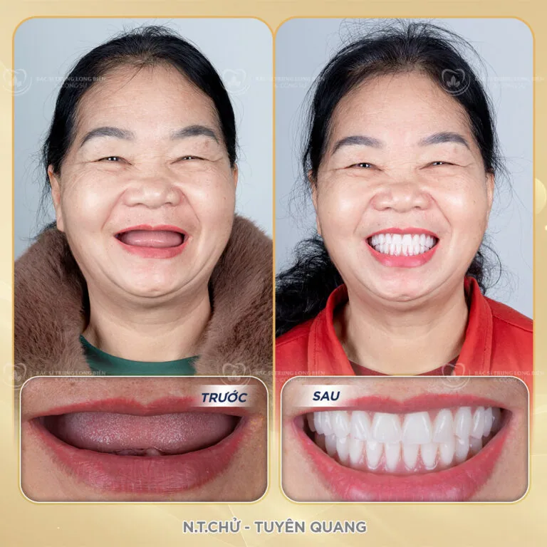 Ảnh trước sau hàm tháo lắp, phục hình răng mất | BS Trung