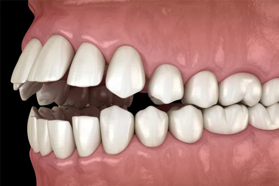 Các loại sai khớp cắn thường gặp - Bác sĩ Trung Long Biên