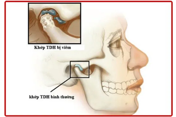 Chữa đau khớp thái dương hàm - Bác sĩ Trung Long Biên