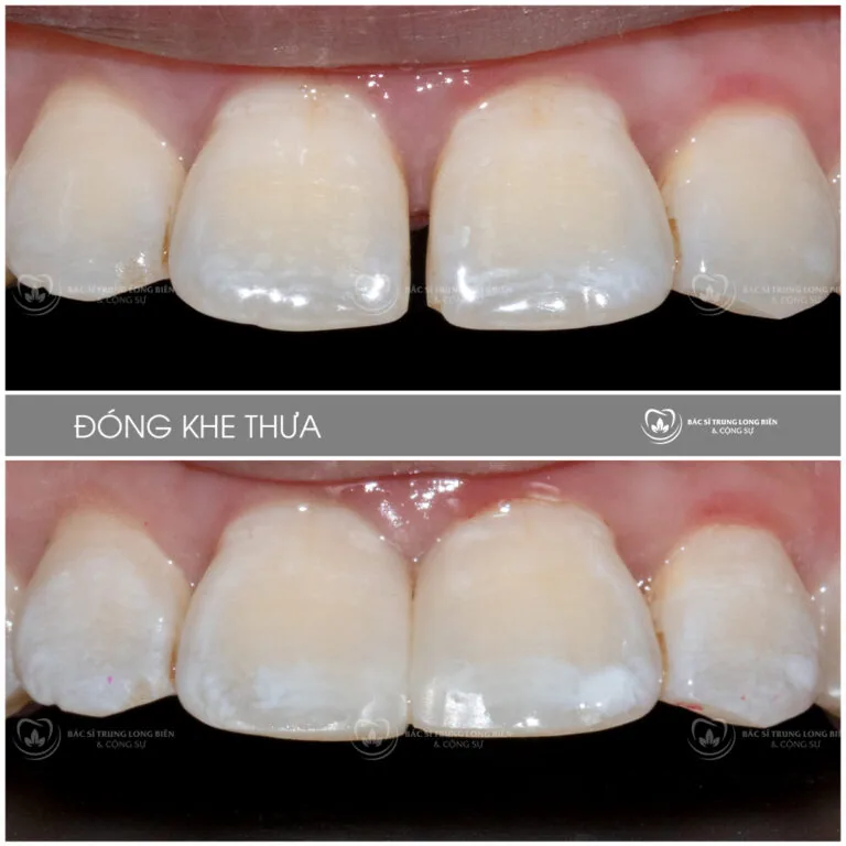 Ảnh trước sau thẩm mỹ răng, đóng khe thưa | BS Trung