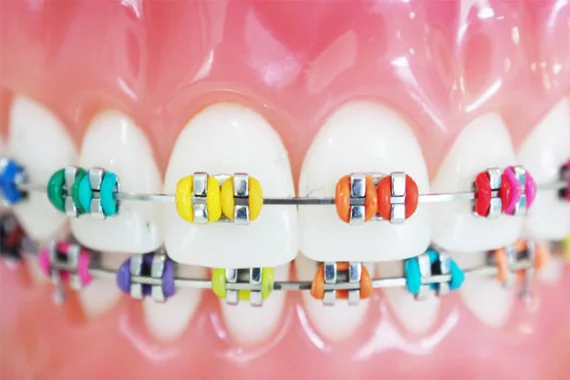 Niềng răng mắc cài - Bác sĩ Trung Long Biên