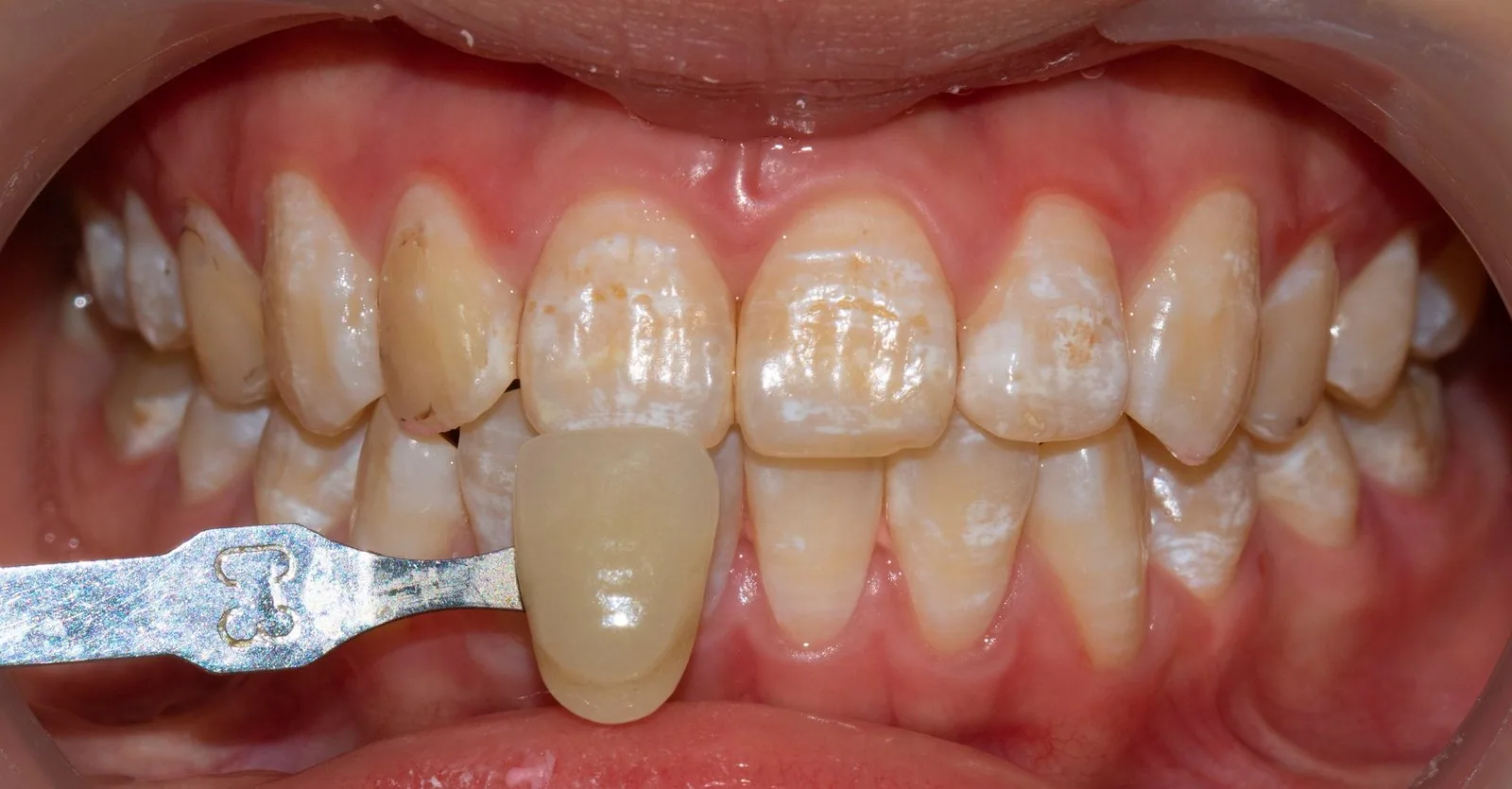 Xóa đốm trắng trên răng bằng công nghệ ICON, không cần mài răng