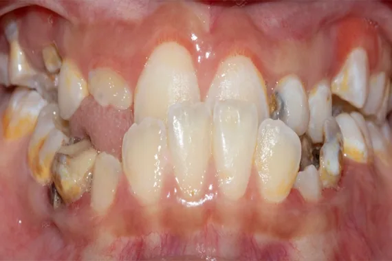 Răng móm gây mất thẩm mỹ - Bác sĩ Trung Long Biên